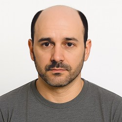 Men's Hair System - Jet Black (Color 1), Ultra-Thin 0.03mm Skin Base, 100% Remy Indian Human Hair